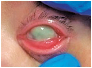 conjunctival hyperemia